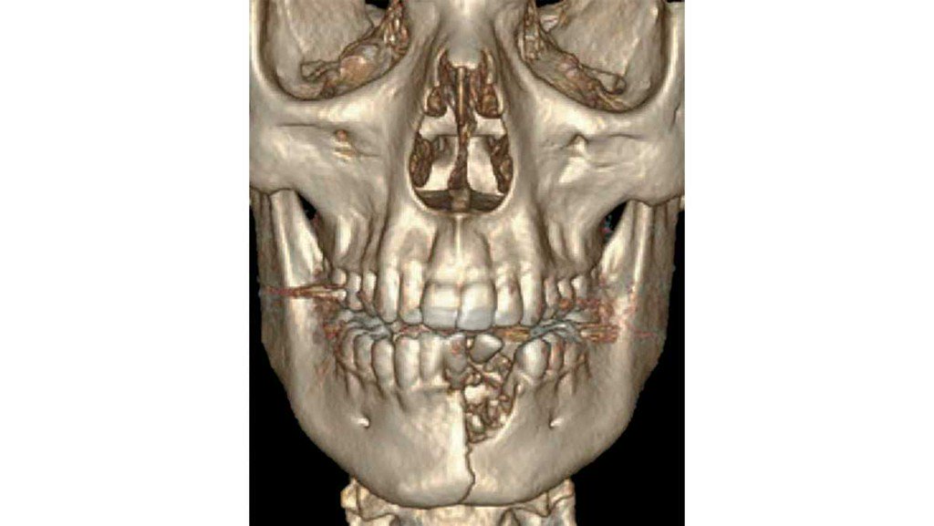 This teen's vape exploded, shattering his jaw. A 17-year-old boy traveled 250 miles with a bloody mouth, broken teeth and a hole in his jaw. 